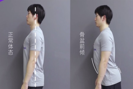你是翘臀还是骨盆前倾？伴有腰痛、腿痛就要注意了