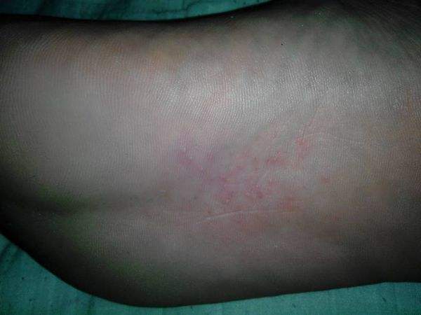 脚心痒是怎么回事 脚心痒一般是细菌感染