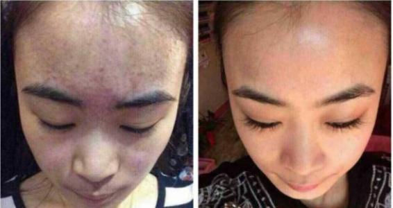 如何快速治疗青春痘 必须做好这几点