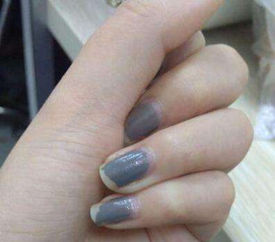 如何根治灰指甲 这些方法能根治灰指甲