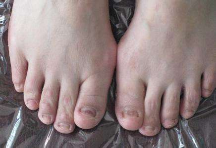 治疗甲癣 两个偏方有效治疗甲癣