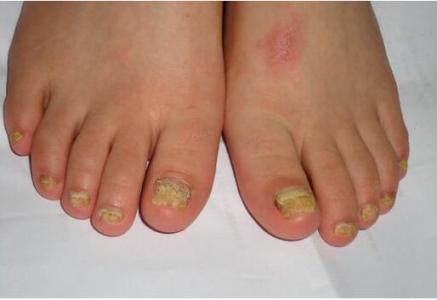 顽固的指甲疾病 治疗灰指甲的最佳方法你知道吗