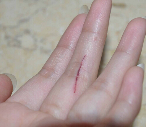 被猫抓伤怎么办