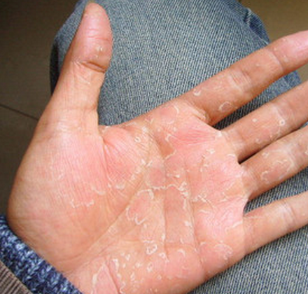 脚上长鸡眼是什么