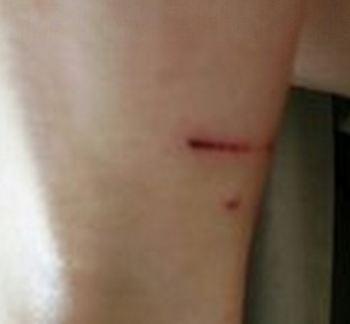 被猫抓伤怎么办