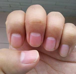 手指甲上没有月牙