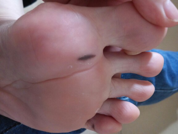 黑色素瘤能活多久