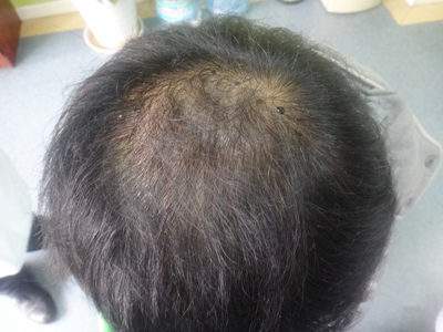 头发稀疏怎么回事及头发稀疏怎么处理的知识点