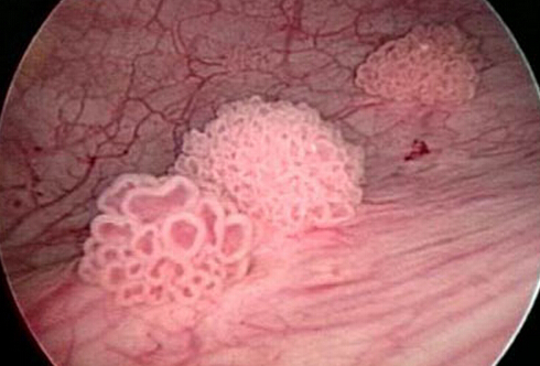 膀胱癌的早期症状