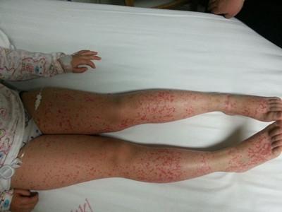 过敏性紫癜严重吗