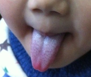 舌苔厚黄是怎么回事