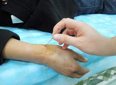 腱鞘炎怎么治疗