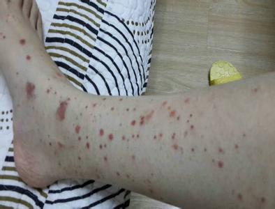 过敏性紫癜严重吗