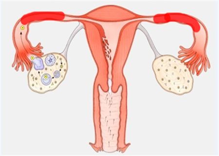 输卵管堵塞怎么治疗