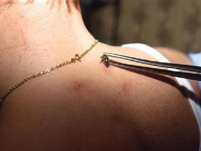 被蜜蜂蛰了怎么处理