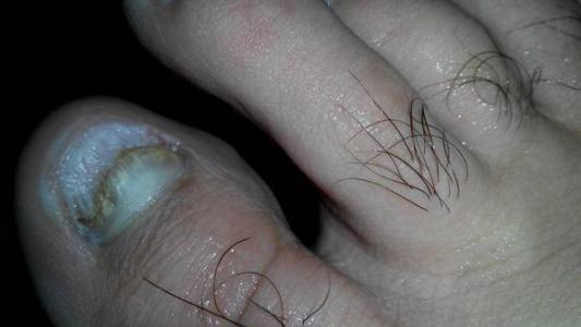 脚趾甲变厚怎么治疗