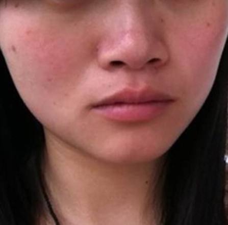脸部过敏