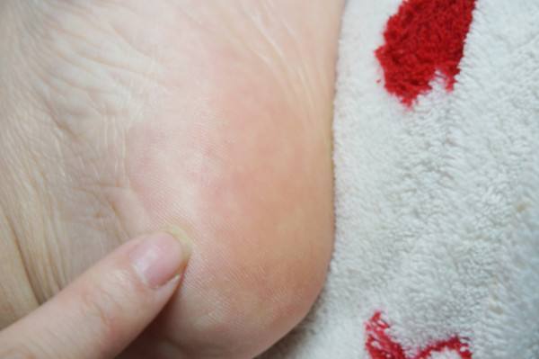 如何去死皮 这些方法简单又高效