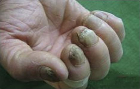 灰指甲怎么治疗偏方