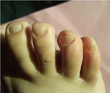 治疗灰指甲民间偏方