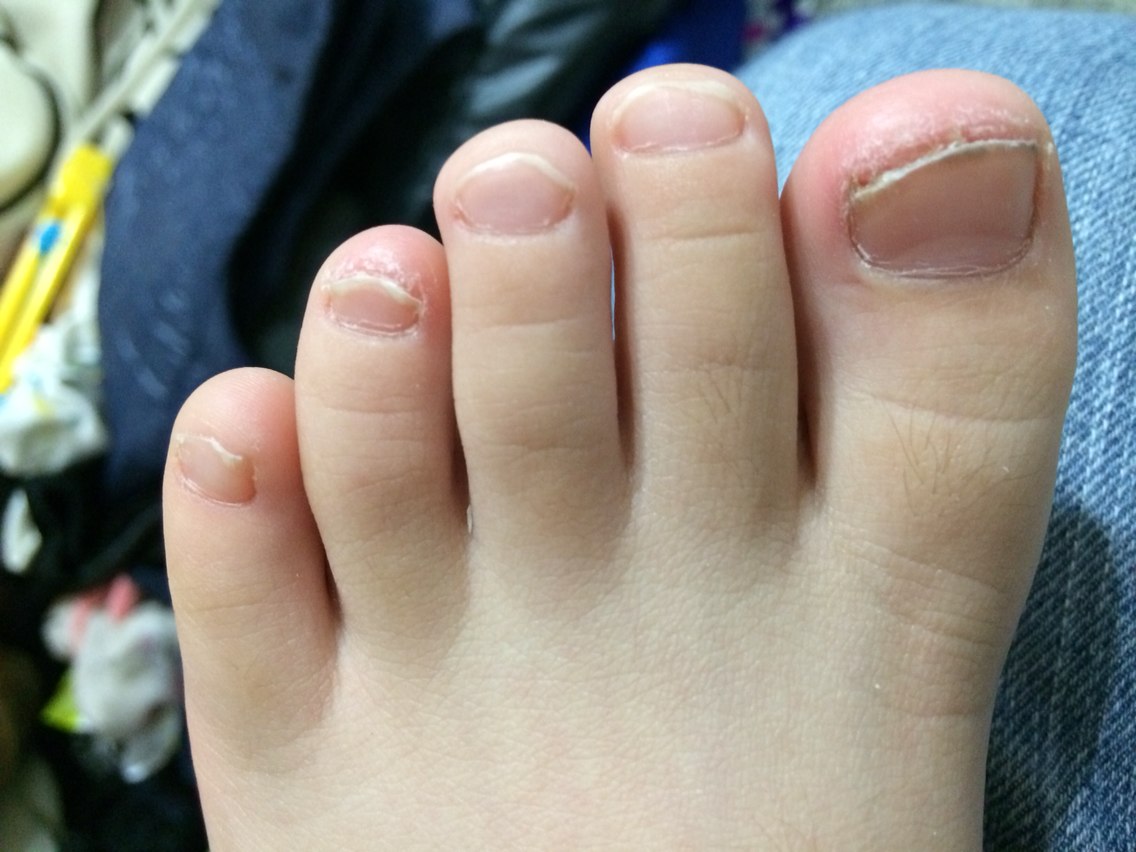 灰指甲治疗方法