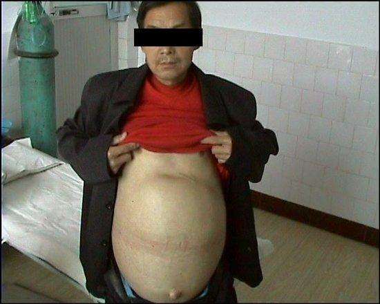 肝脏血管瘤严重吗