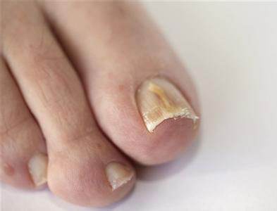 脚趾甲变厚怎么治疗