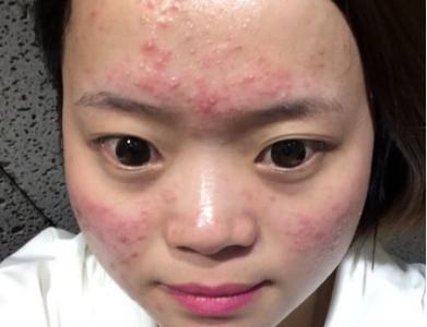 脸部痤疮