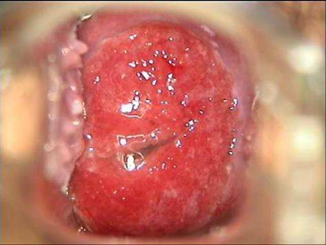 宫颈糜烂是怎么引起的