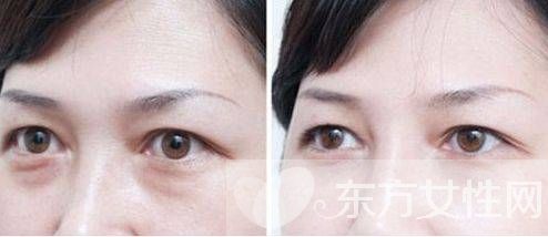 眼部脂肪粒怎么去除 六大方法帮你赶跑脂肪粒