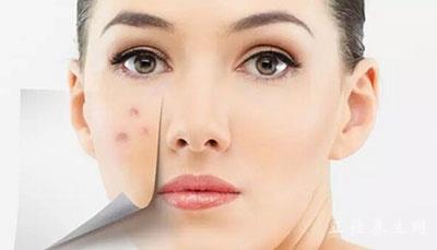 教你祛痘小秘方