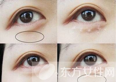 眼部脂肪粒怎么去除 六大方法帮你赶跑脂肪粒