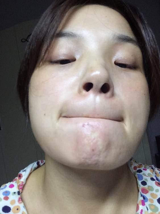 引起下巴痤疮的六大原因 千万不能用手挤