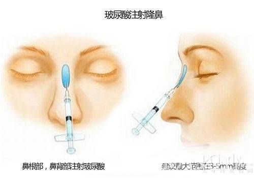 你知道注射玻尿酸需要多少钱吗