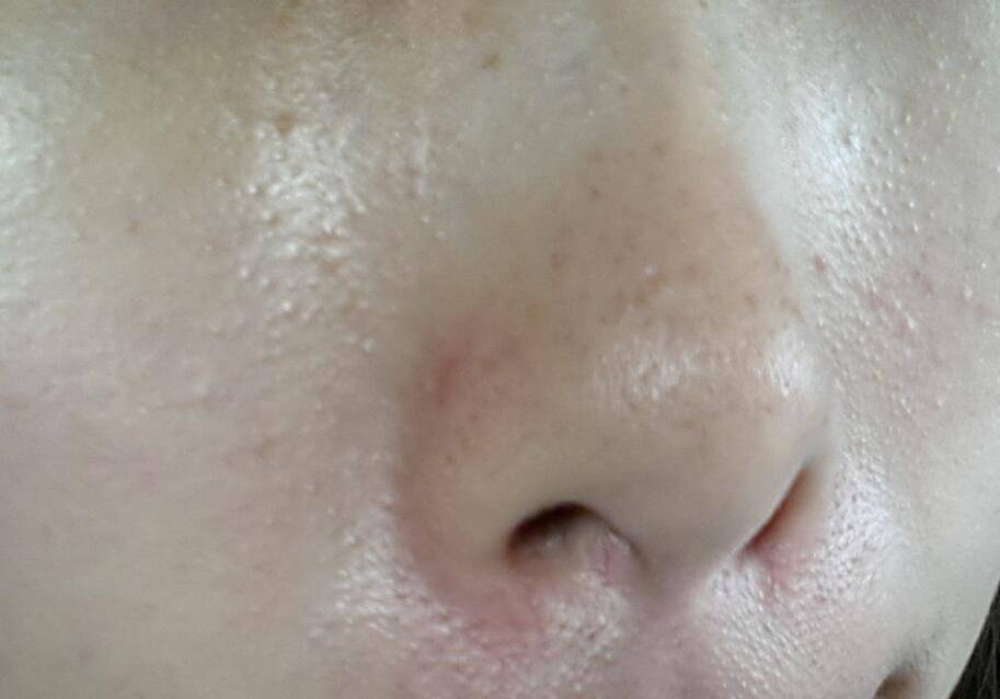 白头粉刺是怎么形成的 该如何去除