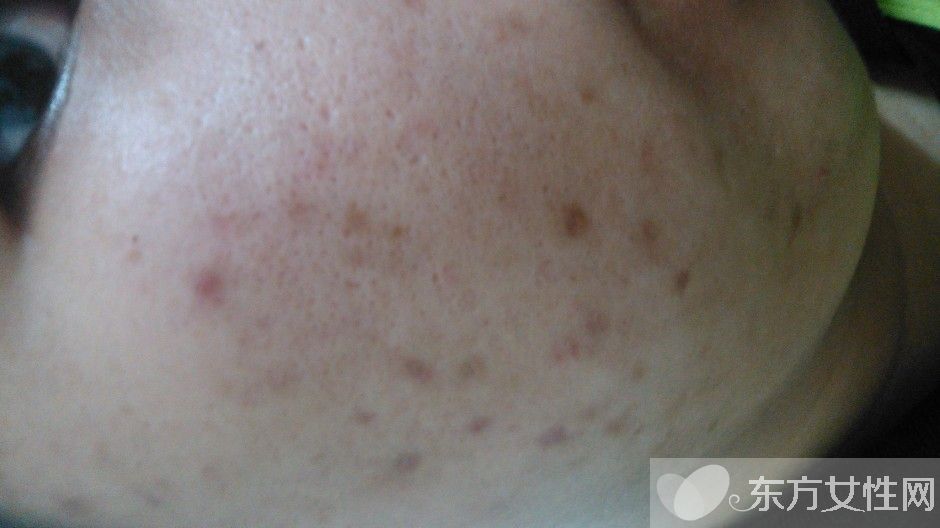 怎么样去痘疤 痘疤和痘印的区别