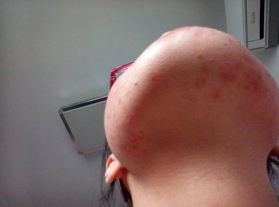 引起下巴痤疮的六大原因 千万不能用手挤