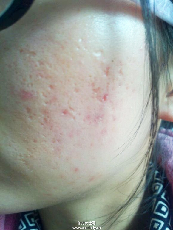 痘坑修复水能快速的解决痘印问题 是真的吗