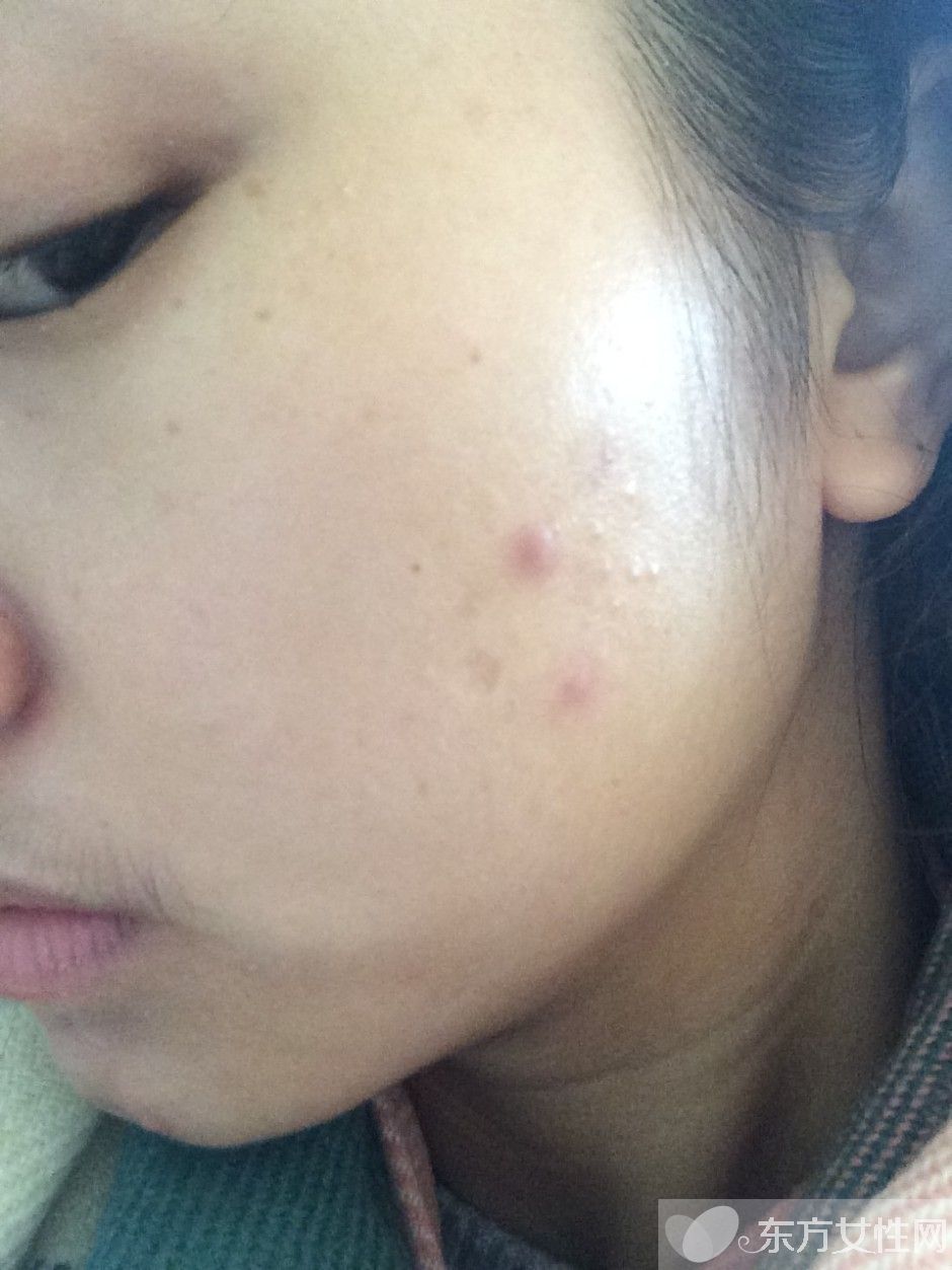 粉刺是怎么形成的 如何有效的去除粉刺