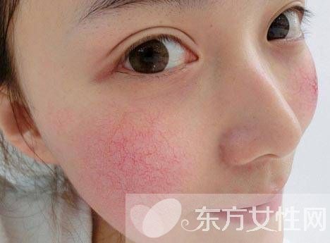 用什么可以去红血丝 这么做可以快速去除红血丝哦
