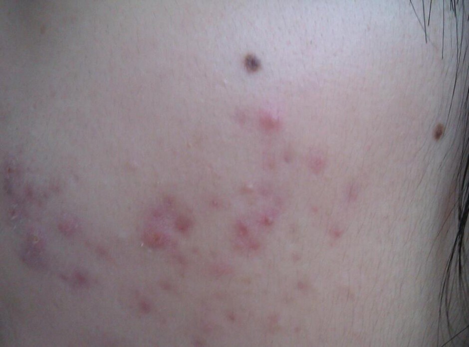 揭右脸长痘痘原因 三小妙招还你白嫩肌肤