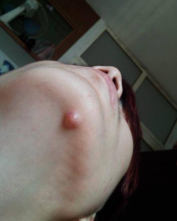 引起下巴痤疮的六大原因 千万不能用手挤