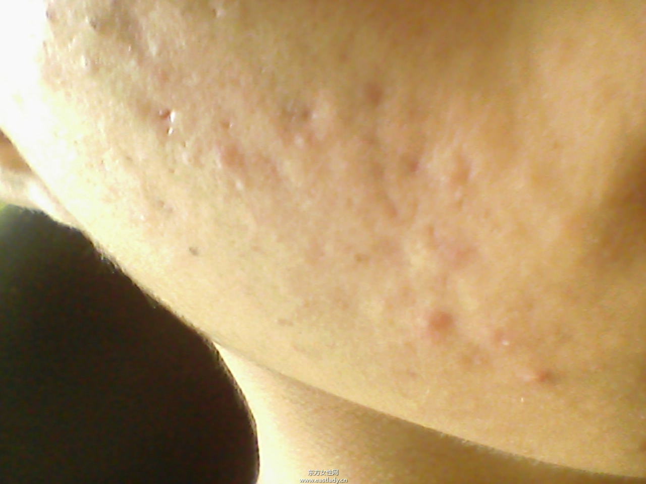 痘坑修复水能快速的解决痘印问题 是真的吗