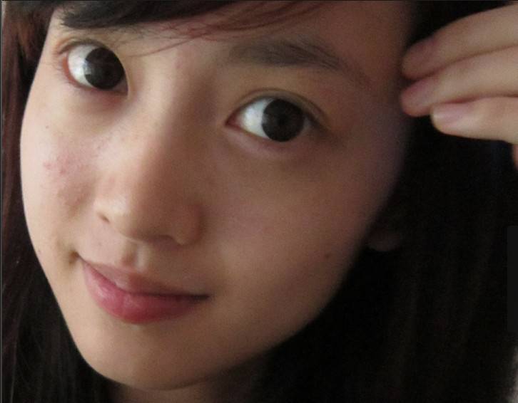 揭右脸长痘痘原因 三小妙招还你白嫩肌肤