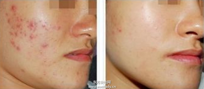 痘坑修复水能快速的解决痘印问题 是真的吗