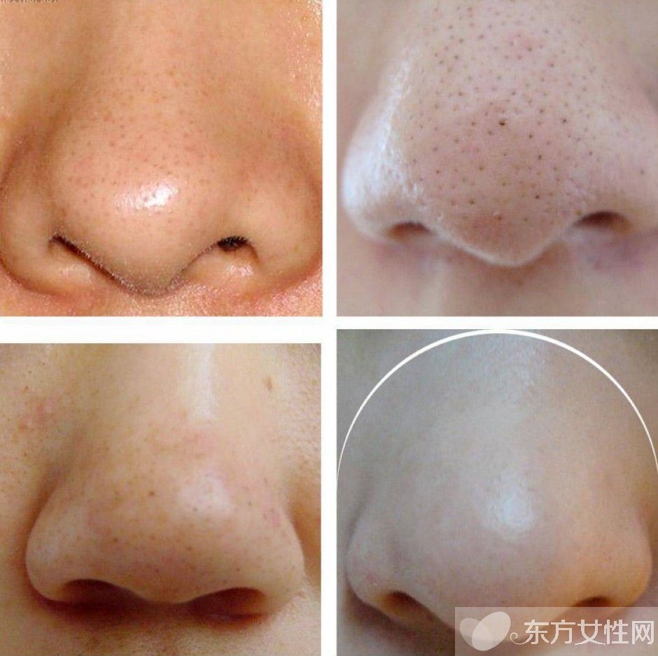 最有效去黑头方法推荐 日常去黑头小妙招超管用