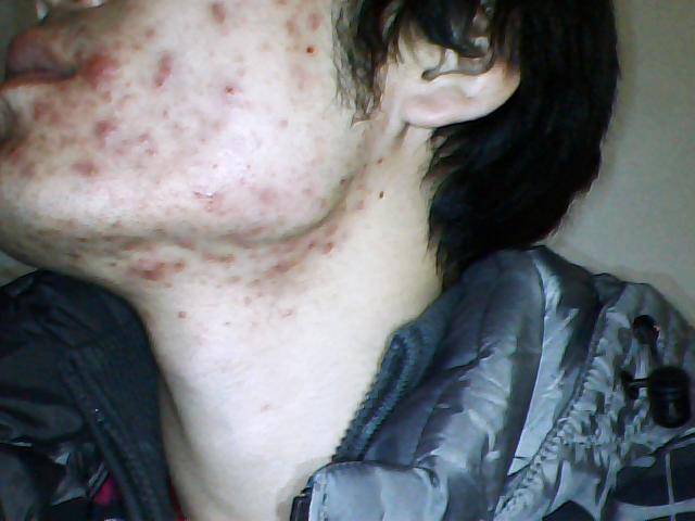 引起下巴痤疮的六大原因 千万不能用手挤