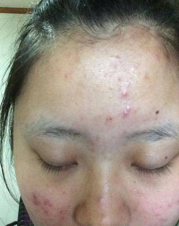 6个引起痤疮粉刺的原因 治疗痤疮粉刺偏方推荐