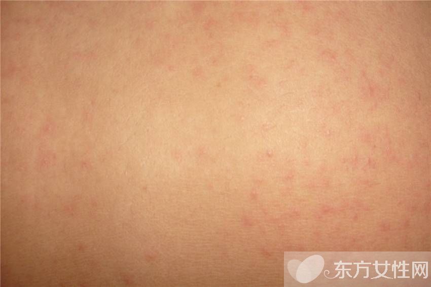 后背上起疙瘩怎么办 如何防止后背上起疙瘩