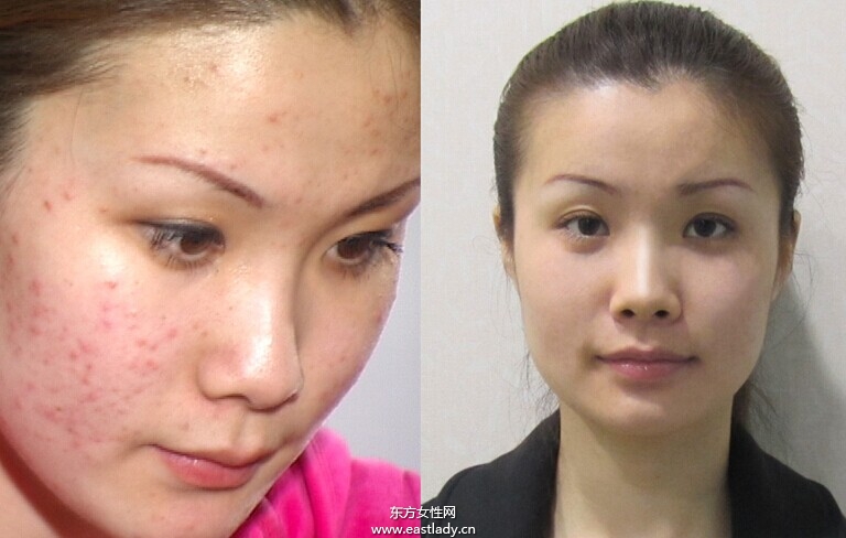 五个简单小妙招 让你跟青春痘疤痕say goodbye